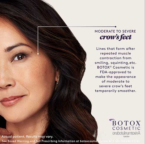 botox for crows feet