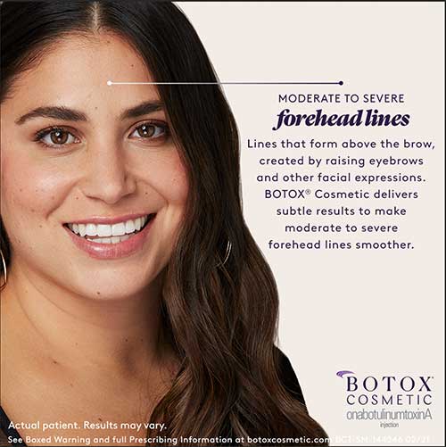 botox for forehead lines