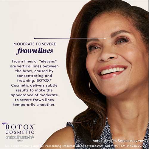 botox for frown lines